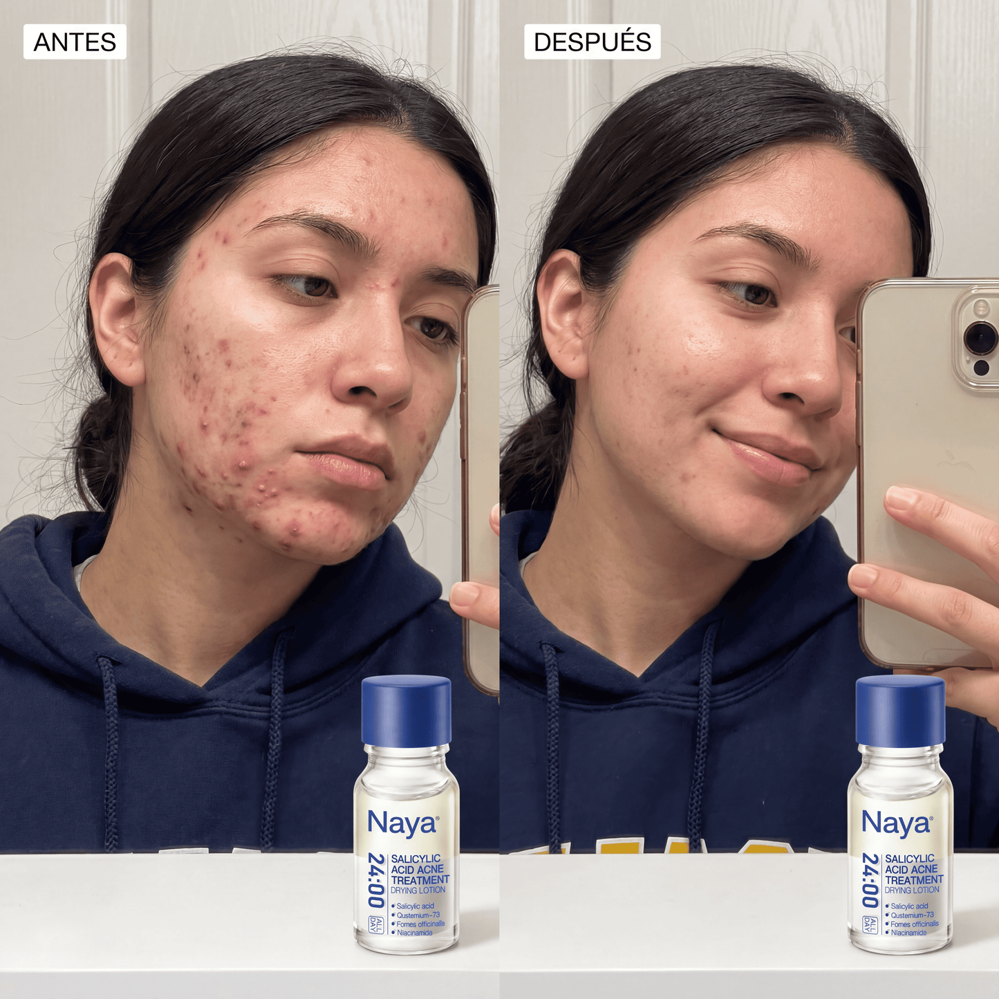 Naya® Loción Secante Anti-Acné